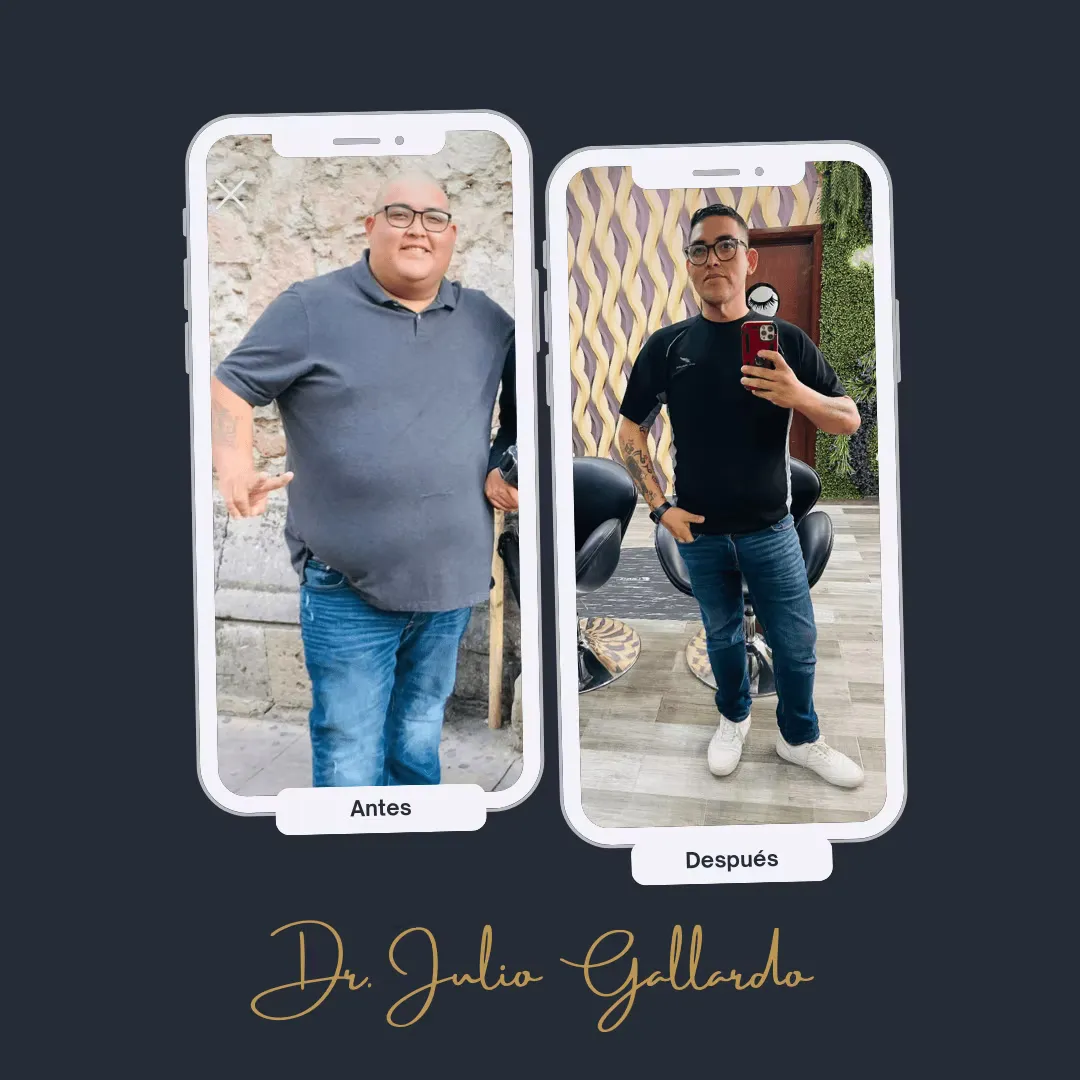 Caso real 10: antes y después de cirugía bariátrica con el Dr. Gallardo