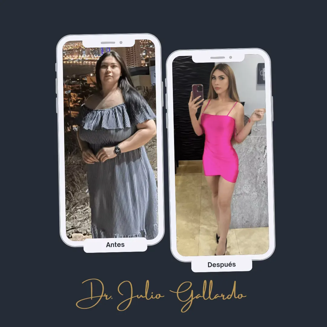 Caso real 2: antes y después de cirugía bariátrica con el Dr. Gallardo