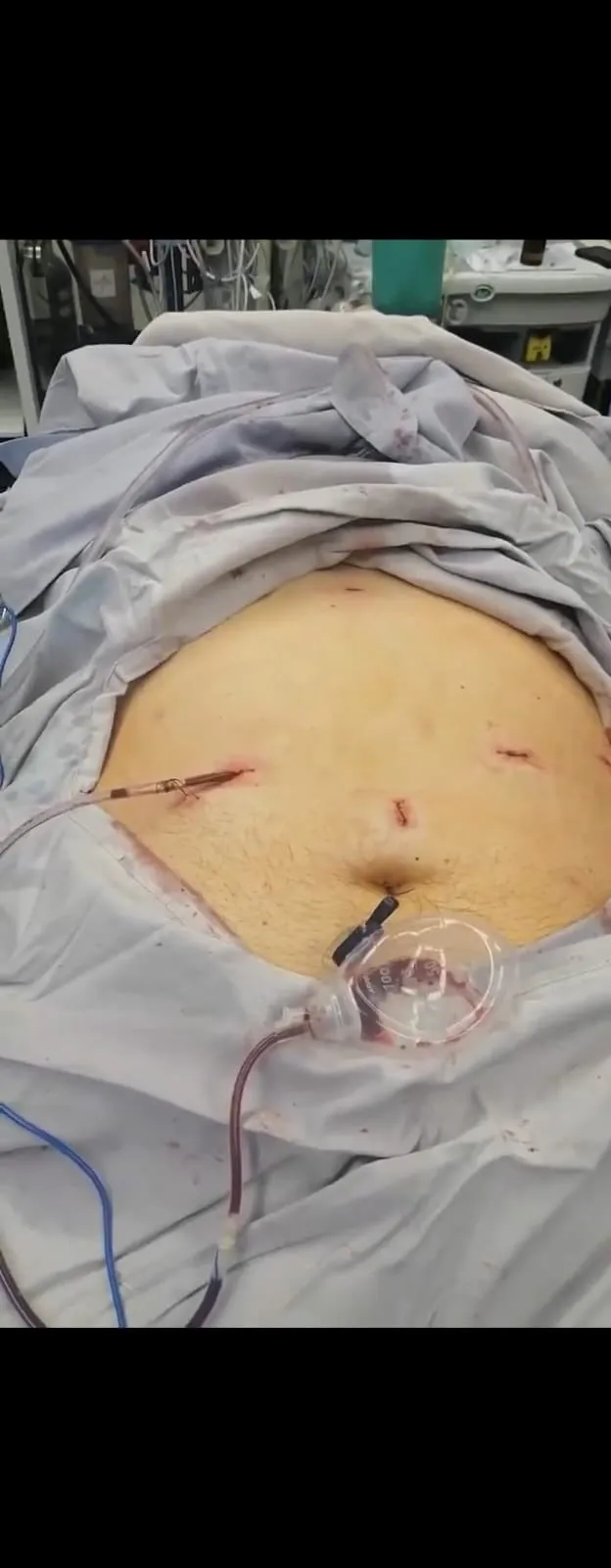 Abdomen durante una cirugía bariátrica convencional con cinco trocares colocados