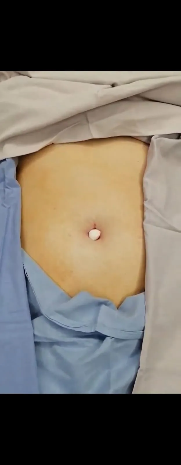 Abdomen operado por micropuerto único: solo el ombligo cubierto