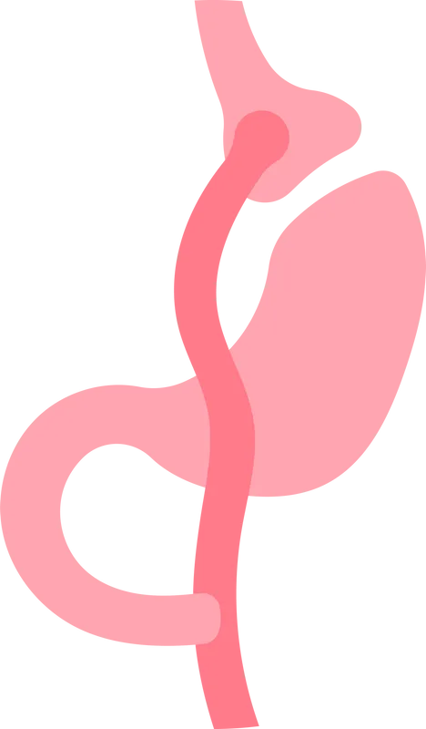 Ilustración de un bypass gástrico