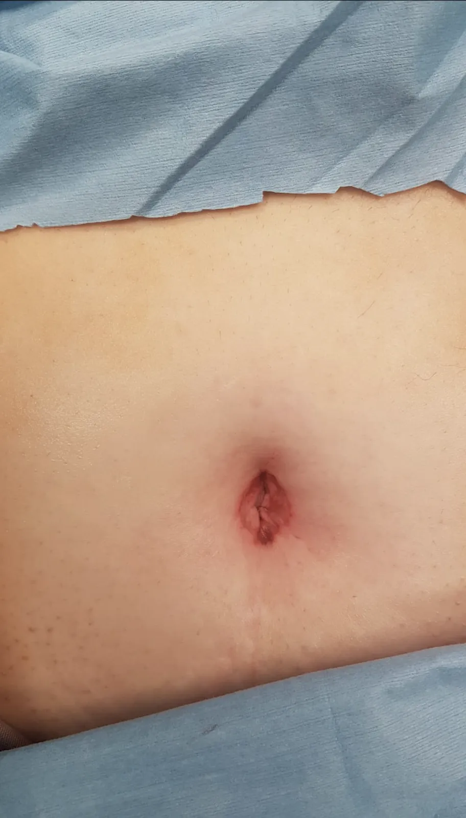 Ombligo de una paciente operada por micropuerto único, con la incisión dentro del pliegue