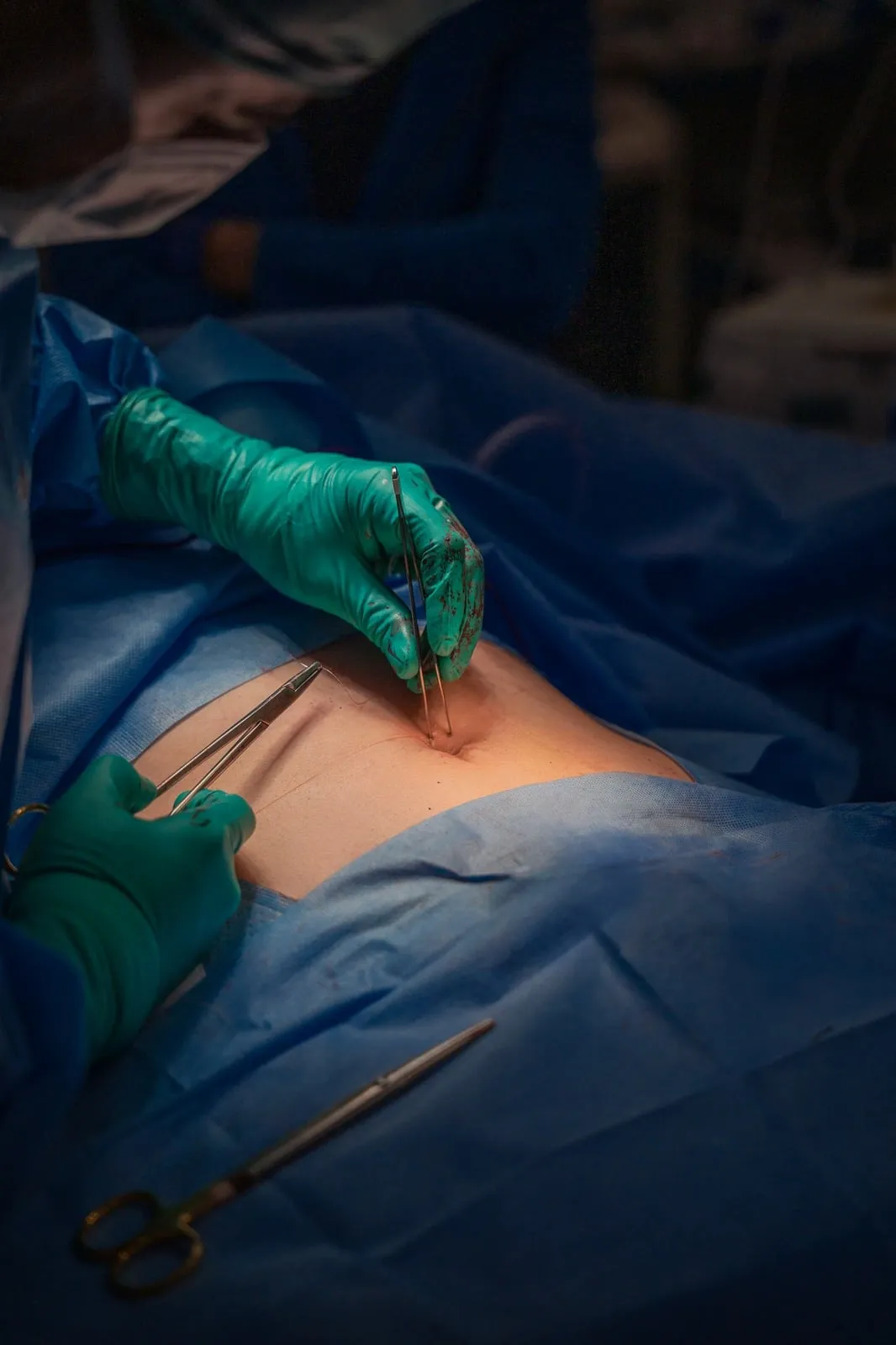 Abdomen al final de la cirugía, con la única incisión en el ombligo