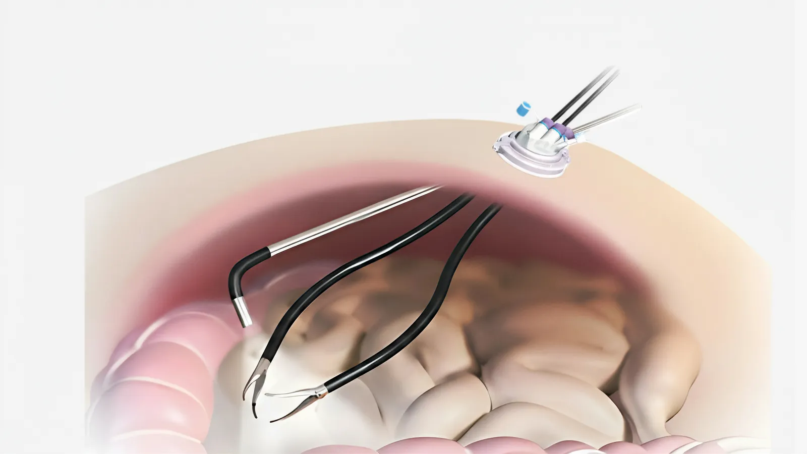Micropuerto Invisible: cámara e instrumental entran por el mismo acceso umbilical