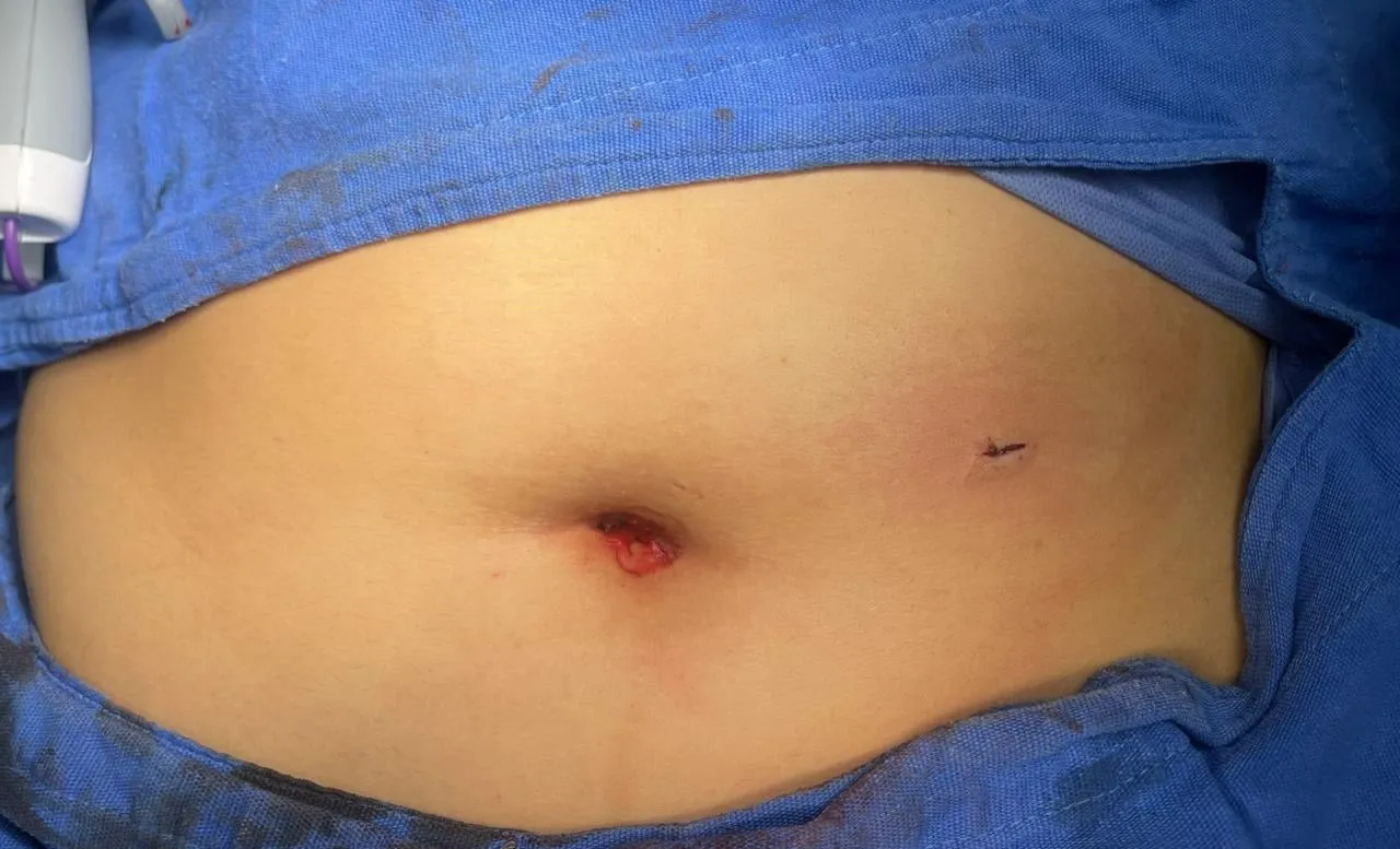 Abdomen operado con la técnica de trocares reducidos, con incisiones muy pequeñas